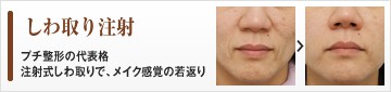 しわ取り注射　プチ整形の代表格　注射式しわ取りで、メイク感覚の若返り