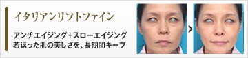 イタリアンリフトファイン　アンチエイジング＋スローエイジング　若返った肌の美しさを、長期間キープ