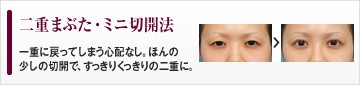 二重まぶた・ミニ切開法　一重に戻ってしまう心配なし。ほんの少しの切開で、すっきりくっきりの二重に。