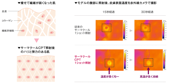 ・痩せて繊維が固くなった肌→サーマクールCPT照射後のハリと弾力のある肌　・モデルの腹部に照射後、皮膚表面温度を赤外線カメラで撮影