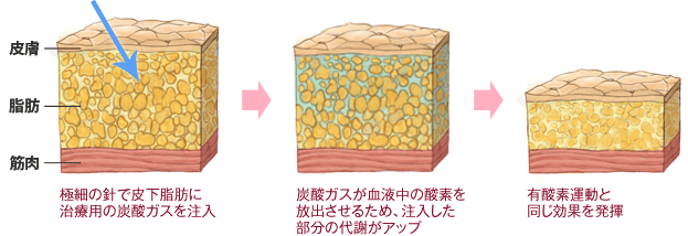 極細の針で皮下脂肪に治療用の炭酸ガスを注入→炭酸ガスが血液中の酸素を放出させるため、注入した部分の代謝がアップ→有酸素運動と同じ効果を発揮