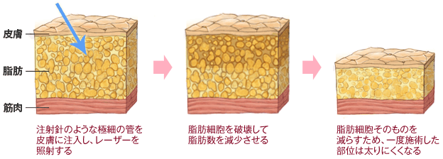 注射針のような極細の管を皮膚に注入し、レーザーを照射する→脂肪細胞を破壊して脂肪数を減少させる→脂肪細胞そのものを減らすため、一度施術した部位は太りにくくなる