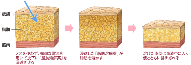 メスを使わず、微弱な電流を用いて皮下に「脂肪溶解薬」を浸透させる→浸透した「脂肪溶解薬」が脂肪を溶かす→溶けた脂肪は血液中に入り便とともに排出される