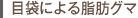 目袋による脂肪グマ