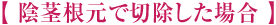陰茎根元で切除した場合