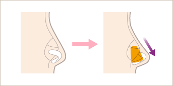 耳介軟骨あるいは肋軟骨を鼻中隔軟骨に縫合固定し延長する