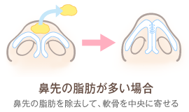鼻先の脂肪が多い場合　鼻先の脂肪を除去して、軟骨を中央に寄せる