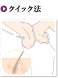 クイック法