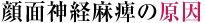 顔面神経麻痺の原因