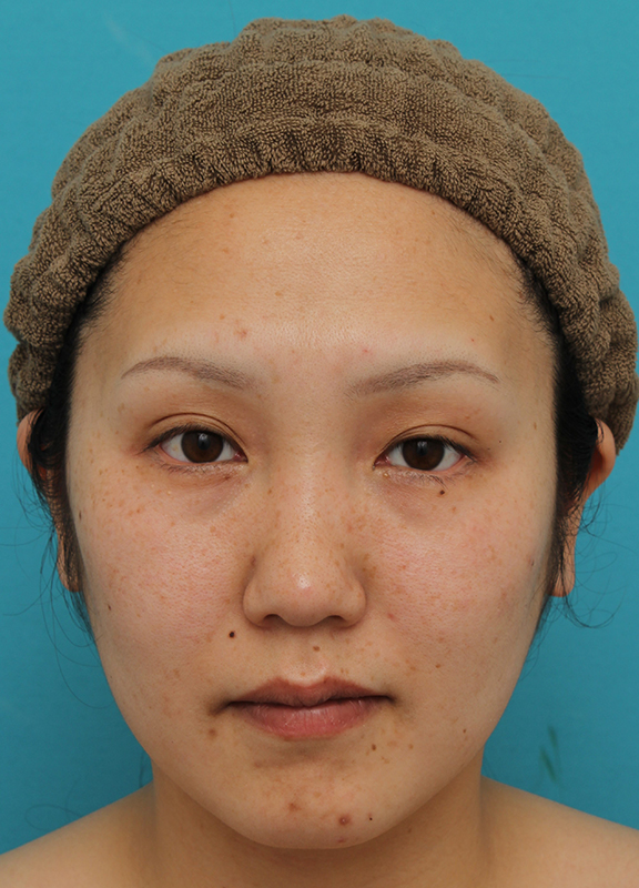 垂れ目（パンダ目）形成（グラマラスライン／下眼瞼下制術）,30代女性に目尻切開・垂れ目形成を行い、目を一回り大きくした症例写真,After（6ヶ月後）,ba_mejiri019_b01.jpg