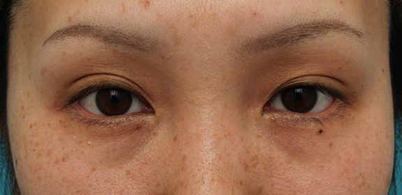 垂れ目（パンダ目）形成（グラマラスライン／下眼瞼下制術）,30代女性に目尻切開・垂れ目形成を行い、目を一回り大きくした症例写真,After（6ヶ月後）,ba_mejiri019_b02.jpg