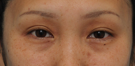 目尻切開,30代女性に目尻切開・垂れ目形成を行い、目を一回り大きくした症例写真,Before,ba_mejiri019_b02.jpg