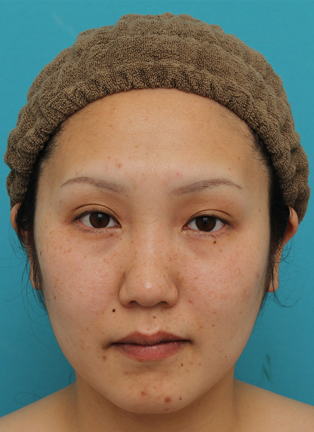 垂れ目（パンダ目）形成（グラマラスライン／下眼瞼下制術）,30代女性に目尻切開・垂れ目形成を行い、目を一回り大きくした症例写真,6ヶ月後,mainpic_mejiri019f.jpg