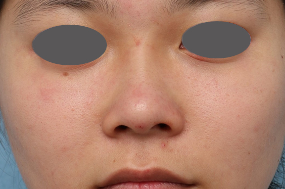 症例写真,隆鼻注射（ヒアルロン酸注射）の症例 鼻がぺちゃんこなのが気になるとのご相談,After,ba_ryubi2038_b01.jpg