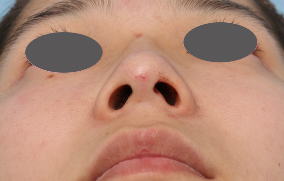 隆鼻注射（ヒアルロン酸注射）,隆鼻注射（ヒアルロン酸注射）の症例 鼻がぺちゃんこなのが気になるとのご相談,After,ba_ryubi2038_b02.jpg