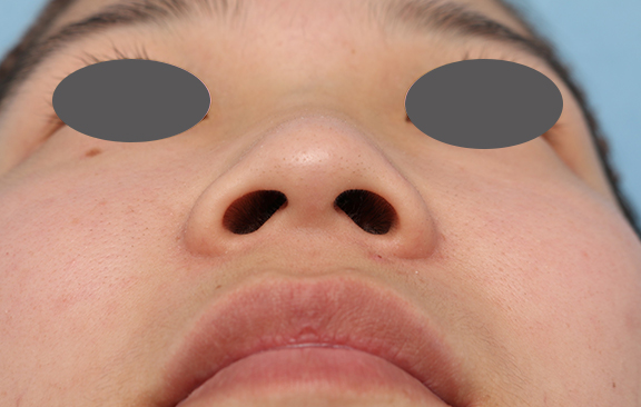 隆鼻注射（ヒアルロン酸注射）,隆鼻注射（ヒアルロン酸注射）の症例 鼻がぺちゃんこなのが気になるとのご相談,Before,ba_ryubi2038_b02.jpg
