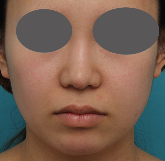 あご注射（ヒアルロン酸）,鼻プロテーゼ、鼻先の耳介軟骨移植、小鼻縮小、顎ヒアルロン酸の症例写真,After（6ヶ月後）,a_ryubi1054_b01.jpg