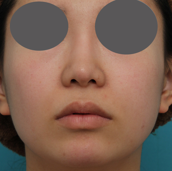 耳介軟骨移植（鼻先を出す）,鼻プロテーゼ、鼻先の耳介軟骨移植、小鼻縮小、顎ヒアルロン酸の症例写真,After（6ヶ月後）,a_ryubi1054_b02.jpg