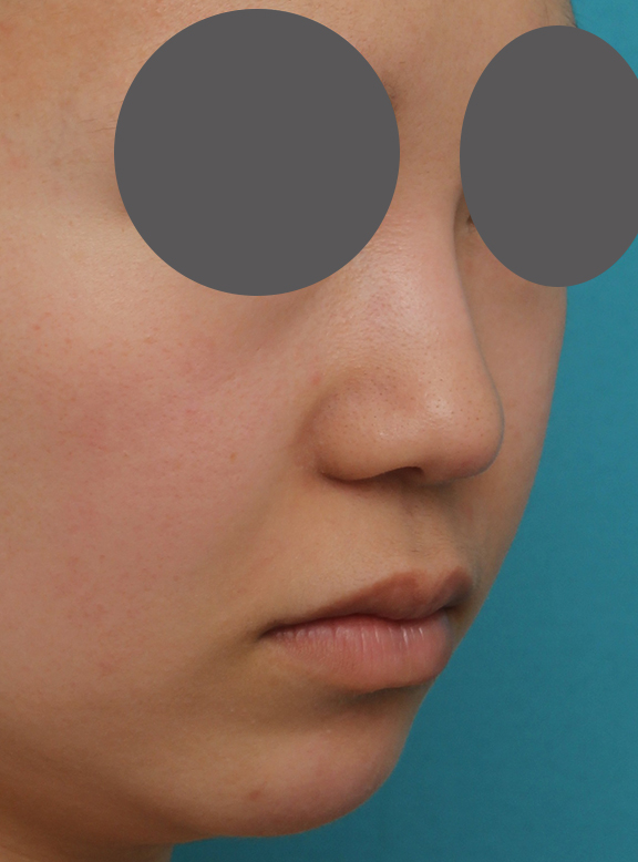 隆鼻術（シリコンプロテーゼ）,鼻プロテーゼ、鼻先の耳介軟骨移植、小鼻縮小、顎ヒアルロン酸の症例写真,After（6ヶ月後）,a_ryubi1054_b03.jpg