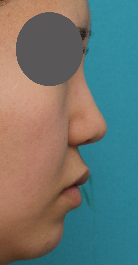 隆鼻術（シリコンプロテーゼ）,鼻プロテーゼ、鼻先の耳介軟骨移植、小鼻縮小、顎ヒアルロン酸の症例写真,After（6ヶ月後）,a_ryubi1054_b04.jpg