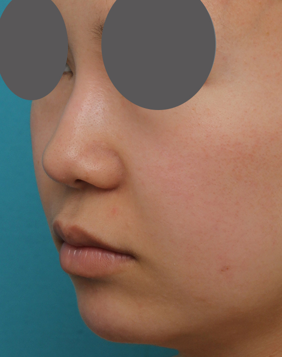 耳介軟骨移植（鼻先を出す）,鼻プロテーゼ、鼻先の耳介軟骨移植、小鼻縮小、顎ヒアルロン酸の症例写真,After（6ヶ月後）,a_ryubi1054_b05.jpg