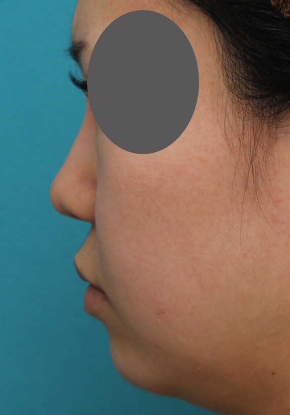 あご注射（ヒアルロン酸）,鼻プロテーゼ、鼻先の耳介軟骨移植、小鼻縮小、顎ヒアルロン酸の症例写真,After（6ヶ月後）,a_ryubi1054_b06.jpg