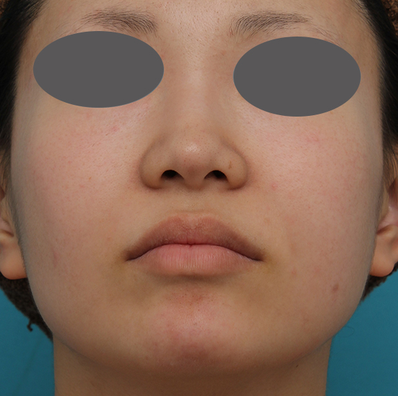 耳介軟骨移植（鼻先を出す）,鼻プロテーゼ、鼻先の耳介軟骨移植、小鼻縮小、顎ヒアルロン酸の症例写真,Before,a_ryubi1054_b02.jpg
