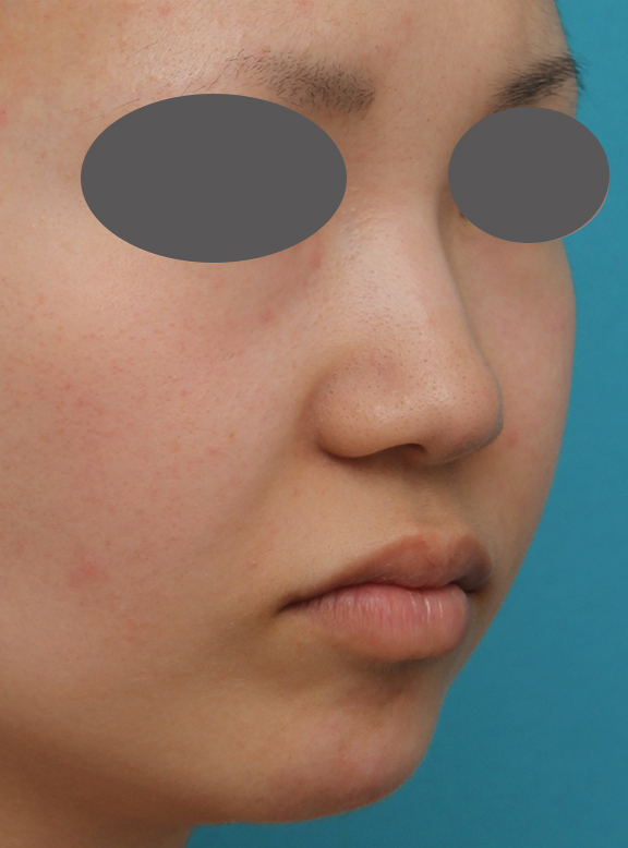 耳介軟骨移植（鼻先を出す）,鼻プロテーゼ、鼻先の耳介軟骨移植、小鼻縮小、顎ヒアルロン酸の症例写真,Before,a_ryubi1054_b03.jpg
