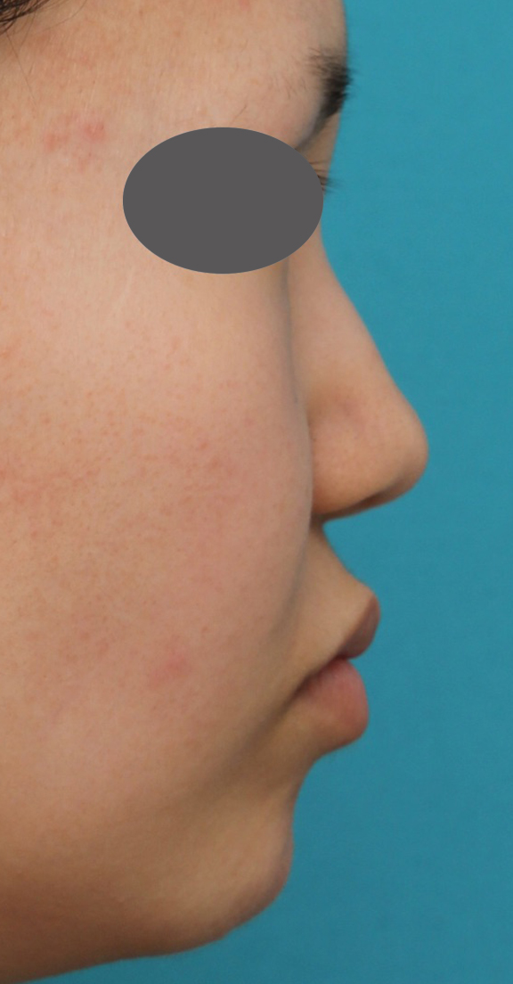 あご注射（ヒアルロン酸）,鼻プロテーゼ、鼻先の耳介軟骨移植、小鼻縮小、顎ヒアルロン酸の症例写真,Before,a_ryubi1054_b04.jpg