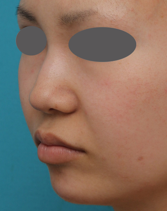 耳介軟骨移植（鼻先を出す）,鼻プロテーゼ、鼻先の耳介軟骨移植、小鼻縮小、顎ヒアルロン酸の症例写真,Before,a_ryubi1054_b05.jpg