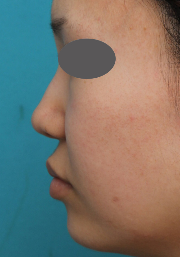 耳介軟骨移植（鼻先を出す）,鼻プロテーゼ、鼻先の耳介軟骨移植、小鼻縮小、顎ヒアルロン酸の症例写真,Before,a_ryubi1054_b06.jpg