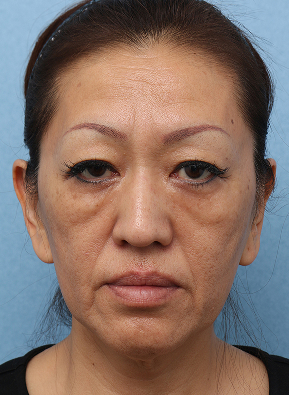 Vシェイプリフト（ヒアルロン酸注射） 50代女性の症例写真,Before,ba_v_shapelift013_b01.jpg
