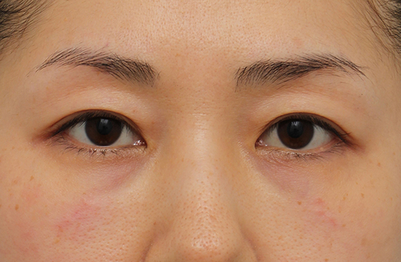 目の下のクマ治療,注射式シワ取り 長期持続型ヒアルロン酸注入,目の下のクマ治療の症例写真,After,ba_kuma017_a01.jpg