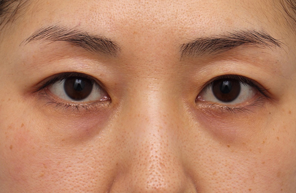 目の下のクマ治療,目の下のクマ治療の症例写真,Before,ba_kuma017_b01.jpg