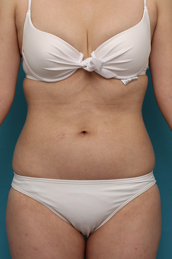 20代女性のお腹周りを、イタリアンメソシェイプでスッキリさせた症例写真,After（3回注射後2週間）,ba_meso042_a01.jpg