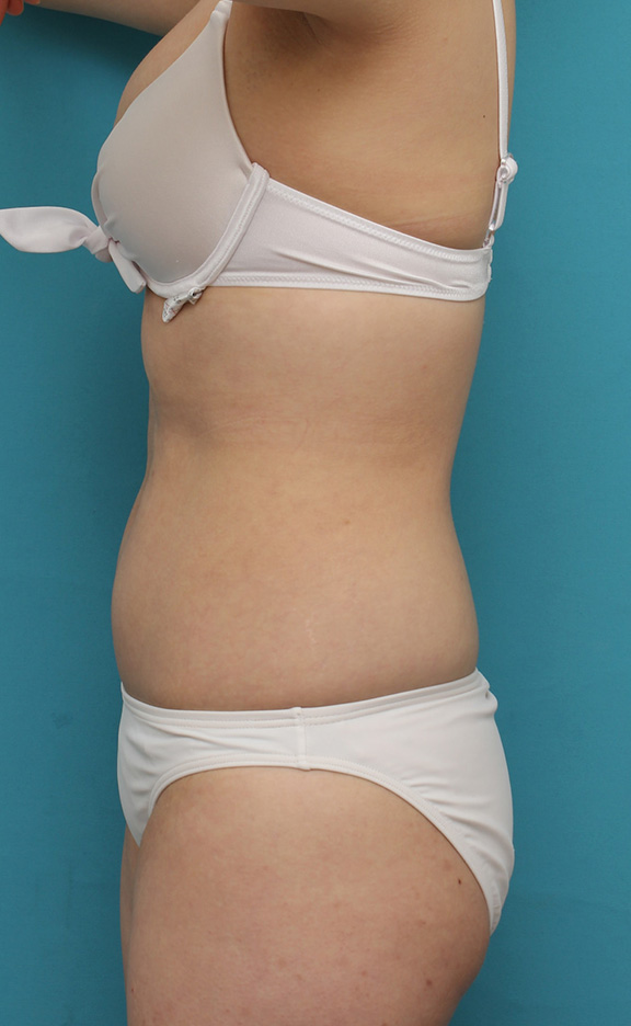 イタリアン・メソシェイプ（イタリアンメソセラピー）・脂肪溶解注射,20代女性のお腹周りを、イタリアンメソシェイプでスッキリさせた症例写真,After（3回注射後2週間）,ba_meso042_b03.jpg