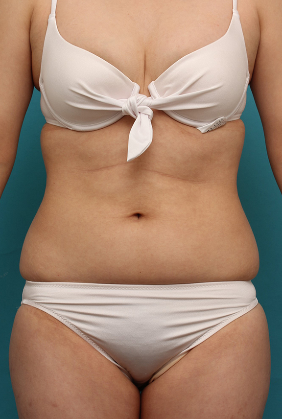 20代女性のお腹周りを、イタリアンメソシェイプでスッキリさせた症例写真,Before,ba_meso042_b01.jpg