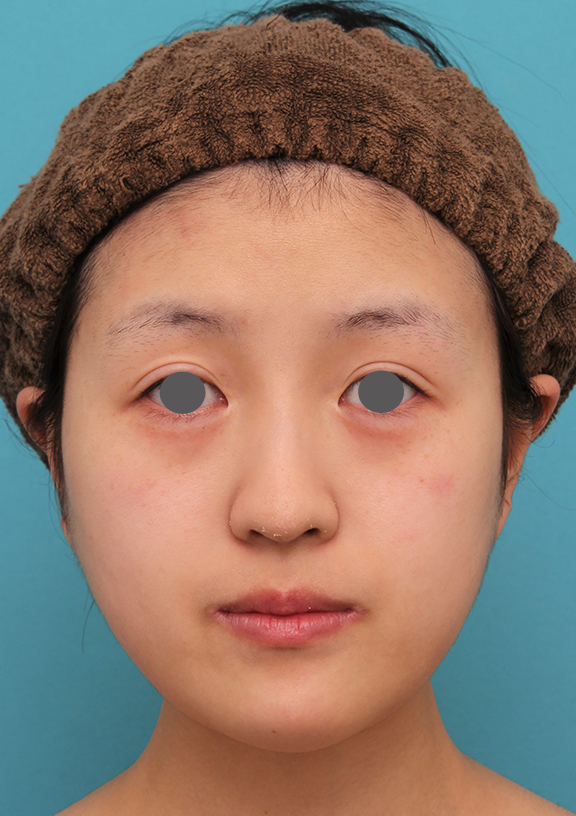 あご形成（シリコンプロテーゼ）,20代女性の顎のシリコンプロテーゼの症例写真,After（6ヶ月後）,ba_ago019_a01.jpg