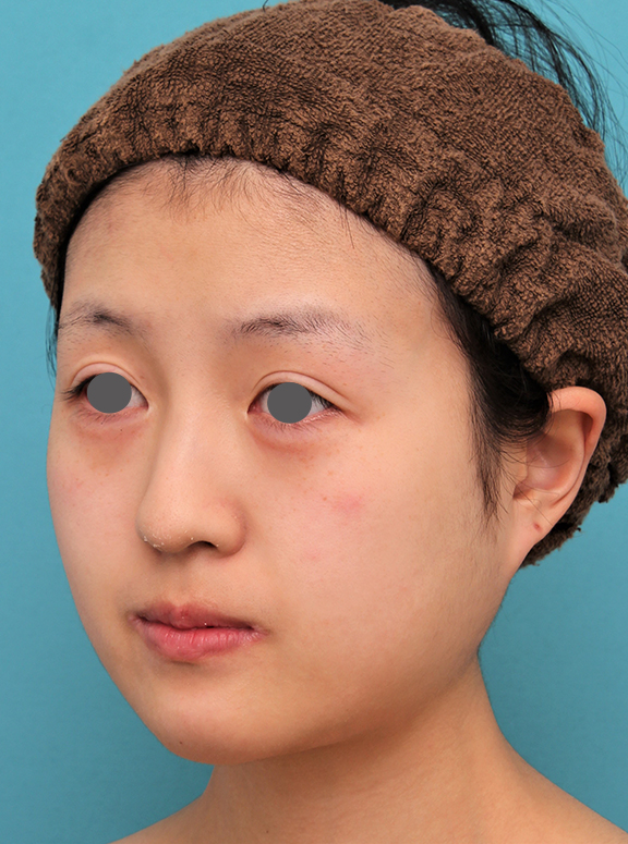 あご形成（シリコンプロテーゼ）,20代女性の顎のシリコンプロテーゼの症例写真,After（6ヶ月後）,ba_ago019_b02.jpg