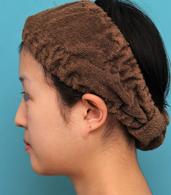 あご形成（シリコンプロテーゼ）,20代女性の顎のシリコンプロテーゼの症例写真,After（6ヶ月後）,ba_ago019_b03.jpg