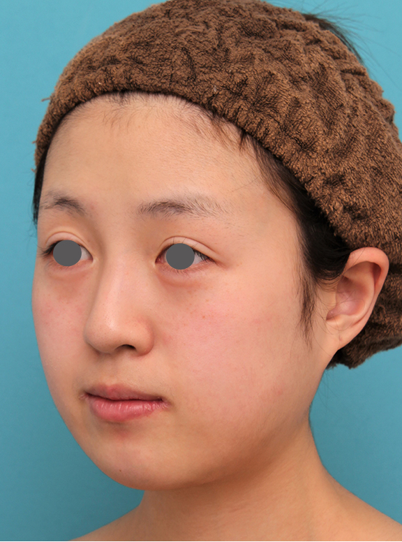 あご形成（シリコンプロテーゼ）,20代女性の顎のシリコンプロテーゼの症例写真,Before,ba_ago019_b02.jpg
