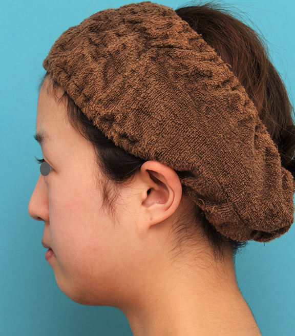あご形成（シリコンプロテーゼ）,20代女性の顎のシリコンプロテーゼの症例写真,Before,ba_ago019_b03.jpg