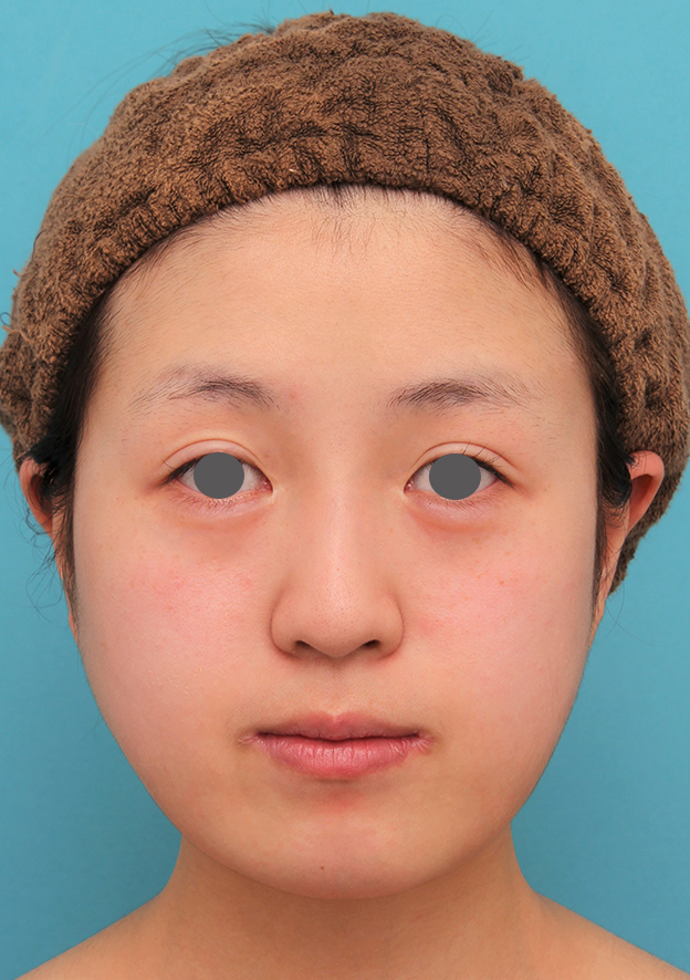 あご形成（シリコンプロテーゼ）,20代女性の顎のシリコンプロテーゼの症例写真,手術前,mainpic_ago019a.jpg