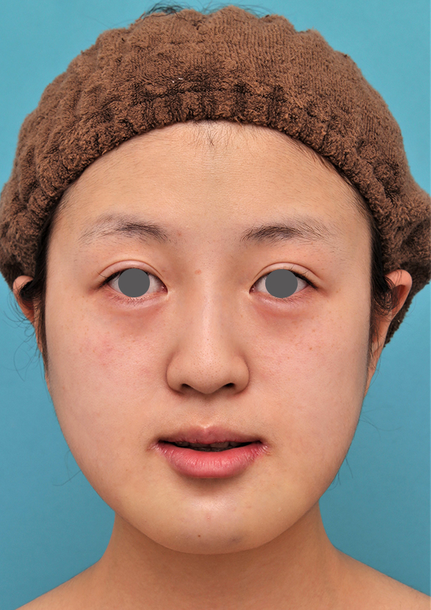 あご形成（シリコンプロテーゼ）,20代女性の顎のシリコンプロテーゼの症例写真,手術直後,mainpic_ago019b.jpg