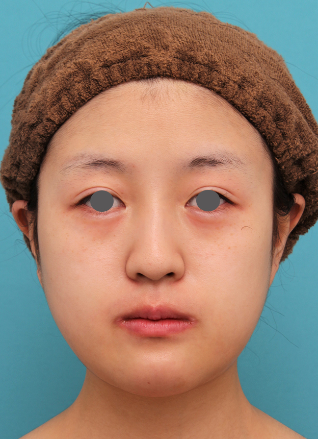 あご形成（シリコンプロテーゼ）,20代女性の顎のシリコンプロテーゼの症例写真,1週間後,mainpic_ago019c.jpg
