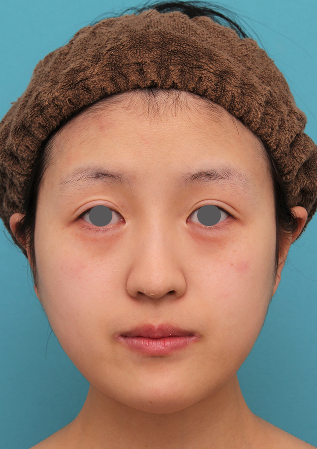 あご形成（シリコンプロテーゼ）,20代女性の顎のシリコンプロテーゼの症例写真,6ヶ月後,mainpic_ago019d.jpg