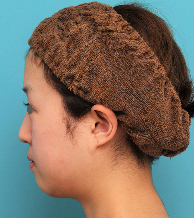 あご形成（シリコンプロテーゼ）,20代女性の顎のシリコンプロテーゼの症例写真,手術前,mainpic_ago019e.jpg