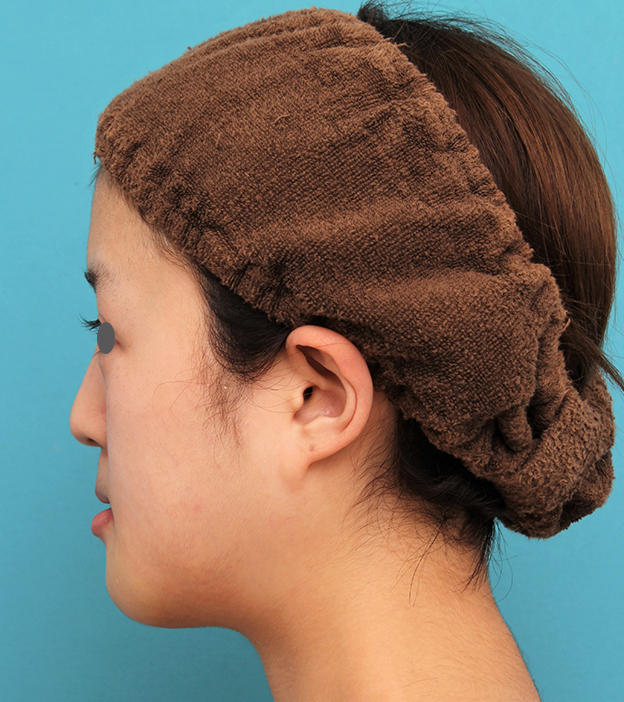 あご形成（シリコンプロテーゼ）,20代女性の顎のシリコンプロテーゼの症例写真,手術直後,mainpic_ago019f.jpg