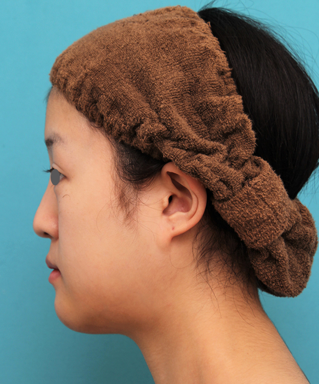 あご形成（シリコンプロテーゼ）,20代女性の顎のシリコンプロテーゼの症例写真,1週間後,mainpic_ago019g.jpg