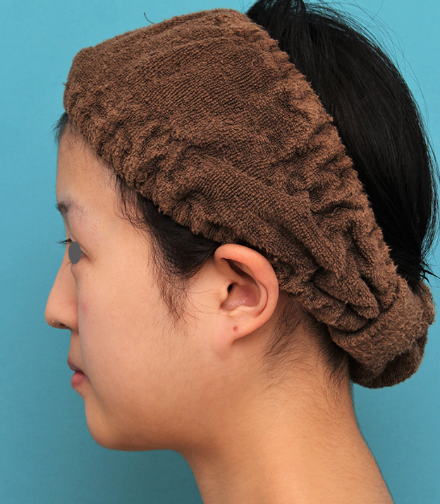 あご形成（シリコンプロテーゼ）,20代女性の顎のシリコンプロテーゼの症例写真,6ヶ月後,mainpic_ago019h.jpg